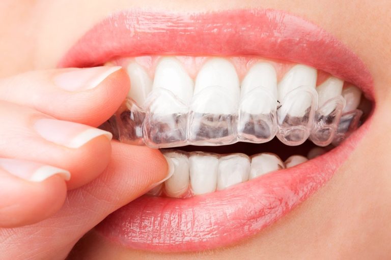 Cuánto cuesta realmente ponerse brackets en México